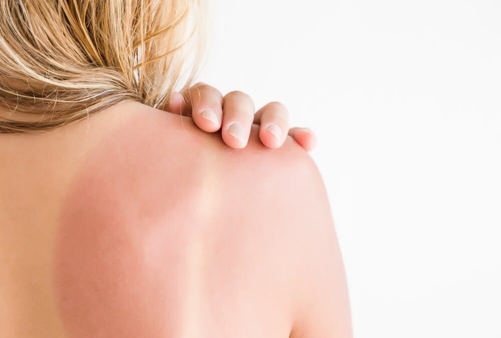 Sunburn Prevention Tips for 2018
